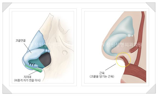 Creating a Soft Line with Hump Nose Correction for a Prominent Bridge and Drooping Tip image 7
