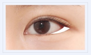 작고 답답한 눈매를 크고 시원스럽게! JW정원성형외과 360° 멀티트임 관련 이미지 5