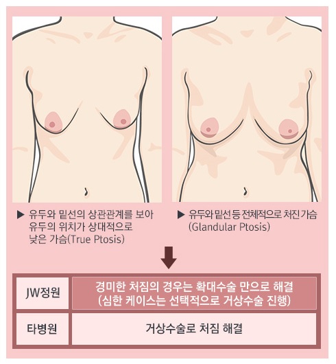 [JW정원성형외과] 처진가슴! 거상없이 확대수술만으로 해결! JW정원 처짐교정확대술 관련 이미지 3