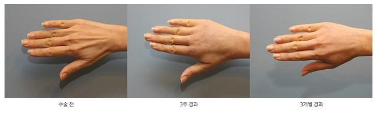 감출 수 없는 세월의 흔적, JW정원성형외과 손등지방이식으로 말끔하게! 관련 이미지 5