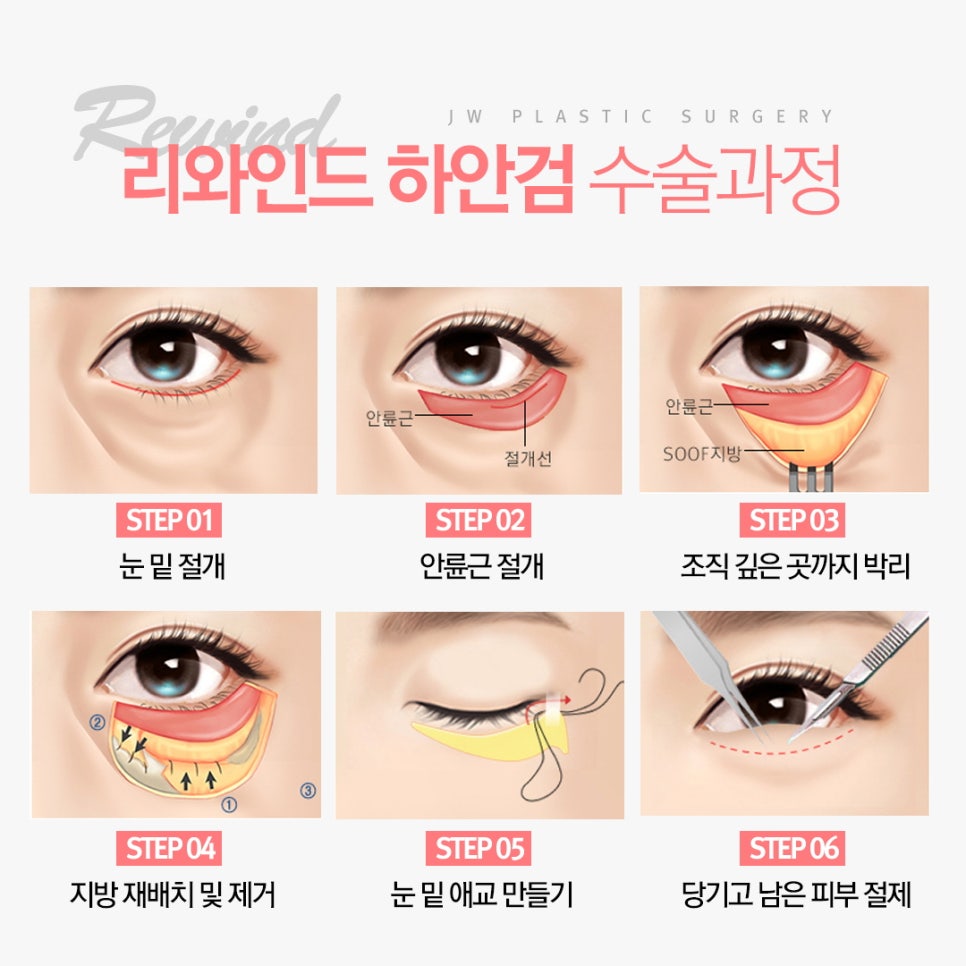 The Secret to a Youthful Eye Shape in Middle Age! Rewind Lower Blepharoplasty image 5