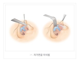 내 얼굴의 중심, 황금비율로! JW정원성형외과 짧은코성형 관련 이미지 6