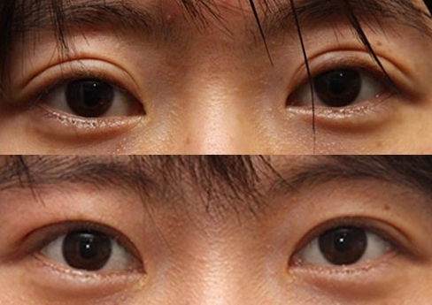 정확한 원인 판단과 시술로 완성하는 JW정원성형외과 눈재수술 관련 이미지 7