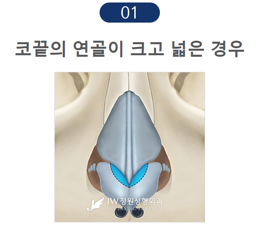 촌스러움 노노! 세련된 라인, JW정원성형외과 콧볼축소 관련 이미지 6
