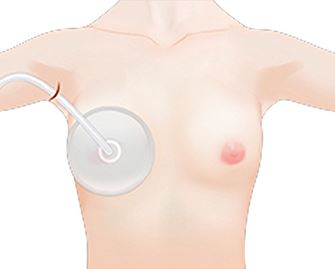 내트렐 510, JW정원성형외과에서 만나보세요! (앨러간) 관련 이미지 8