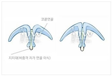 강하고 억센 이미지에서 날렵하고 부드러운 이미지로! JW정원성형외과 매부리코 성형 관련 이미지 4