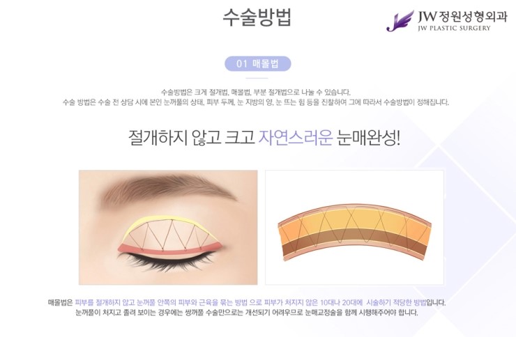 [JW정원성형외과] 나에게 맞는 눈성형 찾기! 관련 이미지 3