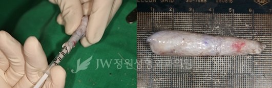 재수술이 아닌 마지막 수술! JW정원성형외과 늑연골코성형 관련 이미지 5
