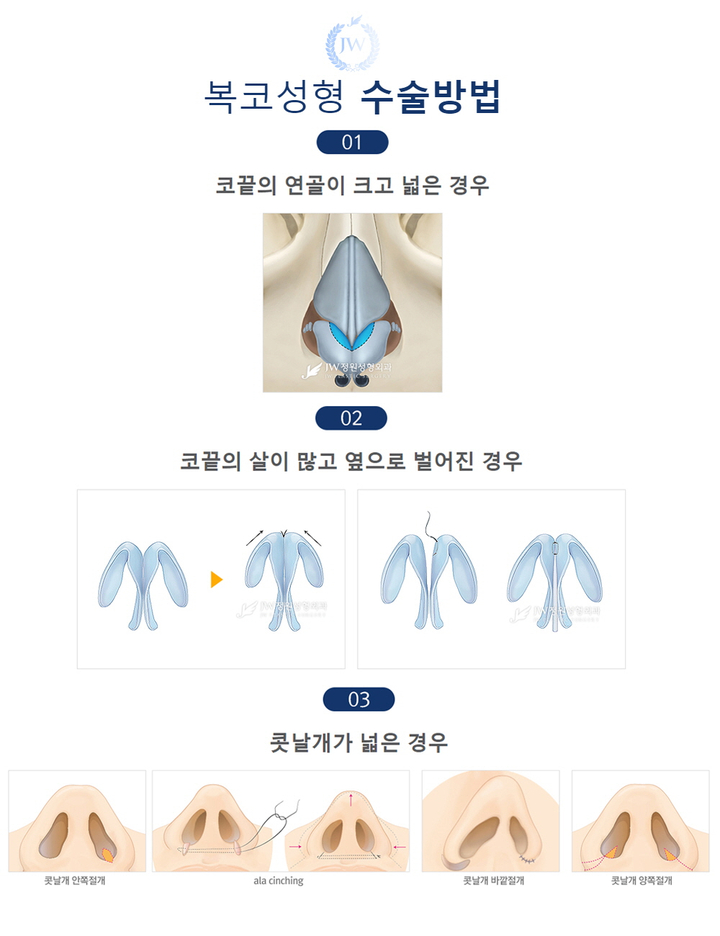 뭉툭하고 넓은 코끝을 콧볼축소 복코교정으로 세련되고 오똑하게! 관련 이미지 4