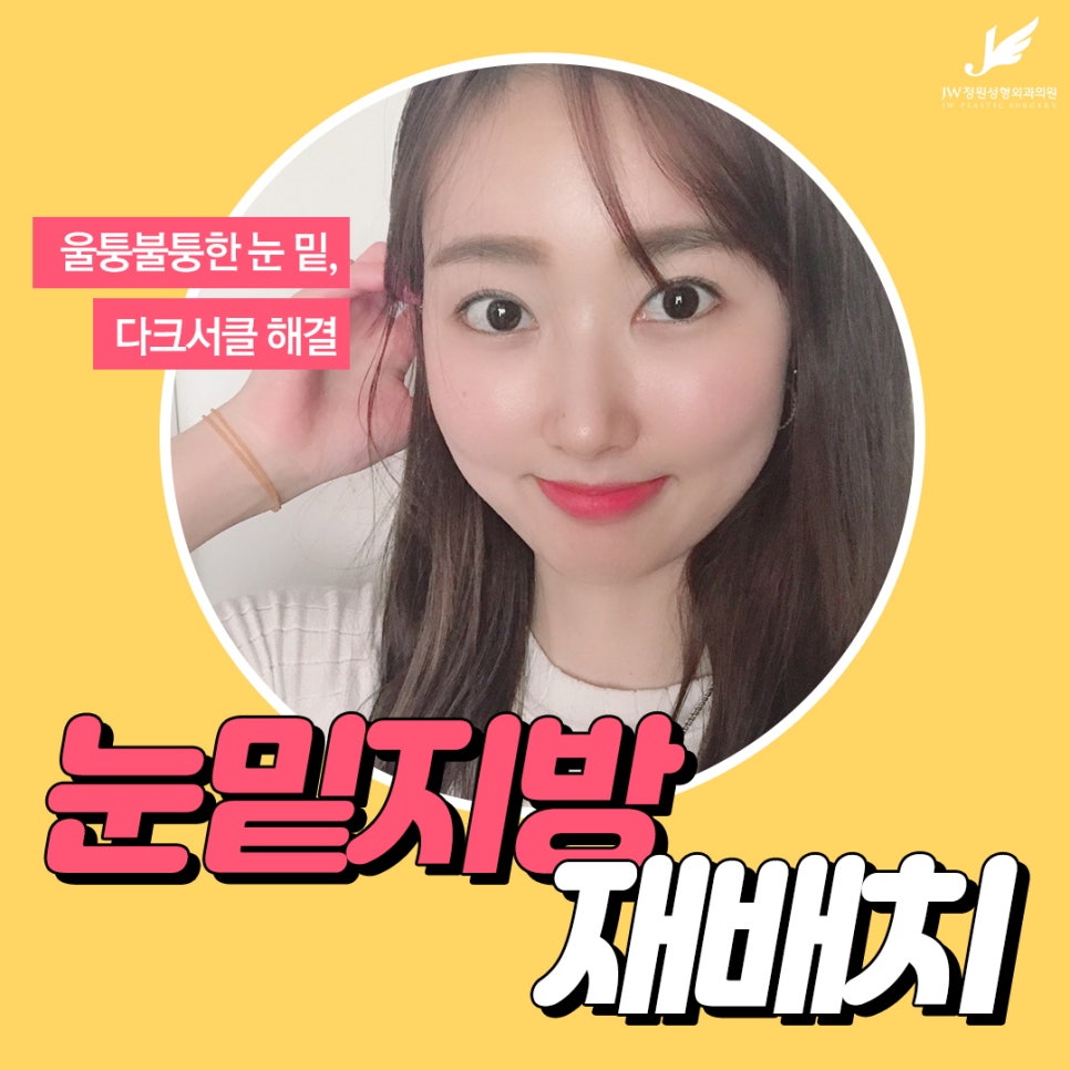다크서클, 눈밑지방재배치로 탄력있는 동안 눈매 완성 관련 이미지 1