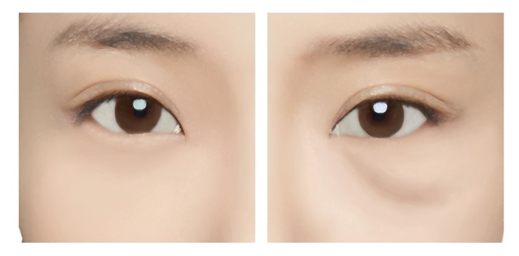 [JW정원성형외과] 눈밑지방재배치 핵심 기술력 관련 이미지 6