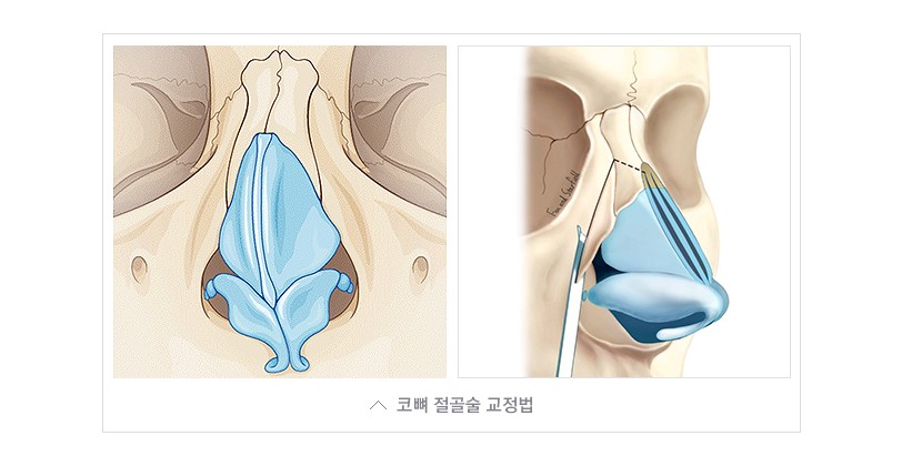Crooked Nose Surgery: Correcting the Tip and Nostril Asymmetry at the Same Time image 3
