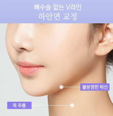 뼈 수술 없이 매끄러운 브이라인얼굴! JW정원성형외과 윤곽교정 관련 이미지 5