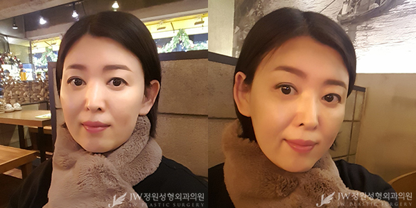 세월의 흔적 JW정원성형외과 이마눈썹거상+리와인드하안검으로 말끔하게♡ 관련 이미지 4
