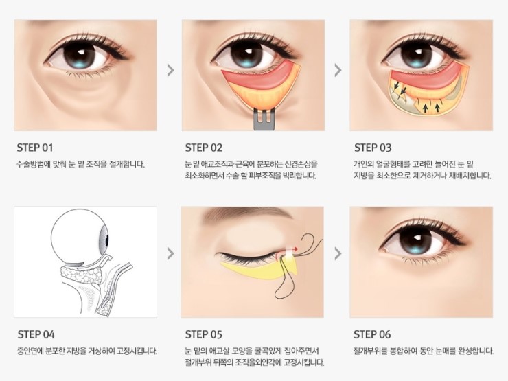환한 눈매와 동안 얼굴을 동시에, JW정원성형외과 REWIND 하안검 관련 이미지 7