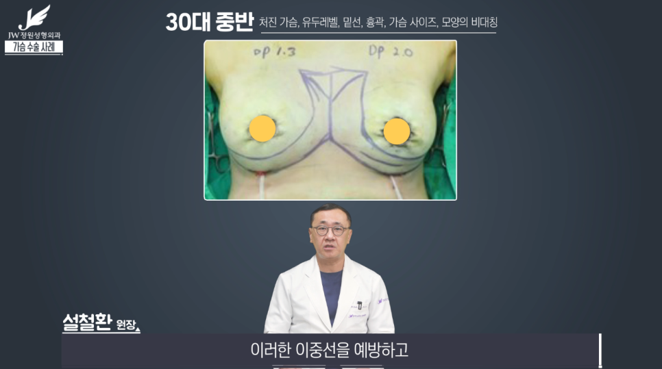 처진가슴교정 치밀한 계획으로 완성도는 UP! 【강남 JW정원성형외과】 관련 이미지 9