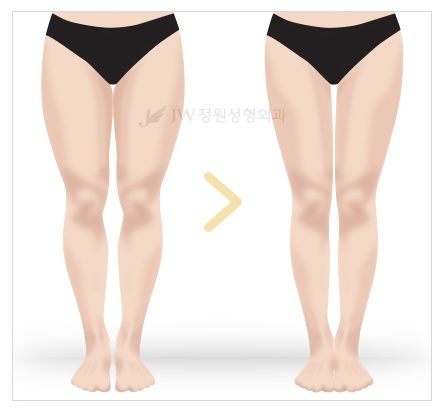 두꺼운 허벅지, 울퉁불퉁 종아리알! JW정원성형외과 모델핏 다리교정으로 매끈하고 날씬하게! 관련 이미지 2
