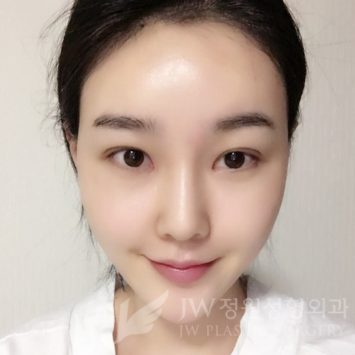 이마눈썹리프팅,눈매교정술,앞트임복원,코성형,지방이식 &rArr; JW정원성형외과에서! 관련 이미지 16
