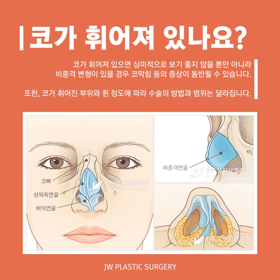 휜코교정 근본적인 미용/기능 개선(코막힘, 비염, 두통 등) 관련 이미지 2