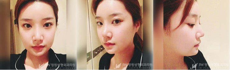 [JW정원성형외과] 안면윤곽 코성형 리얼 후기!!! 관련 이미지 3