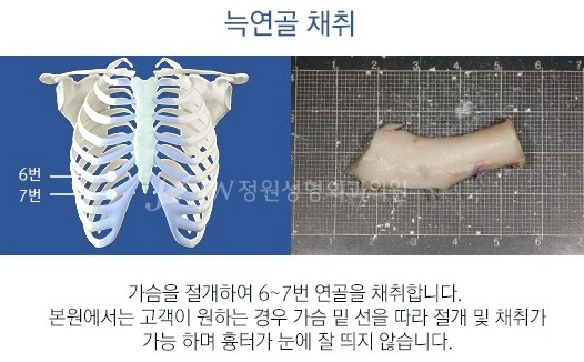 재수술이 아닌 마지막 수술! JW정원성형외과 늑연골코성형 관련 이미지 3