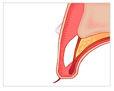 눈재수술! 병원선택부터 신중하게! JW정원성형외과 쌍꺼풀 재수술 관련 이미지 7