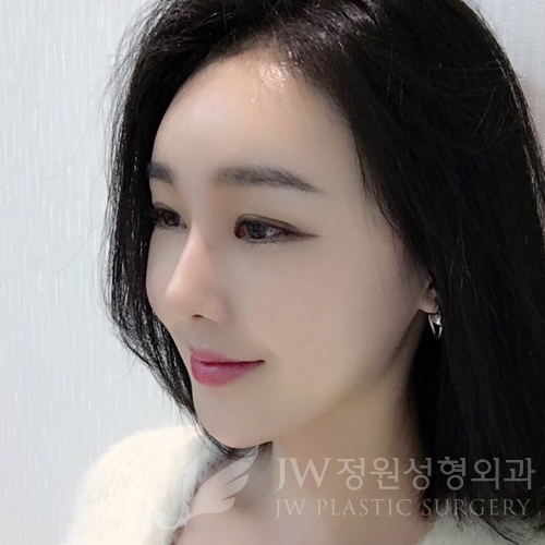 이마눈썹리프팅,눈매교정술,앞트임복원,코성형,지방이식 ⇒ JW정원성형외과에서! 관련 이미지 18