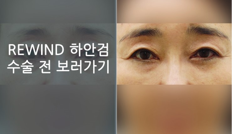 JW정원성형외과▶ 3세대 하안검수술 관련 이미지 5