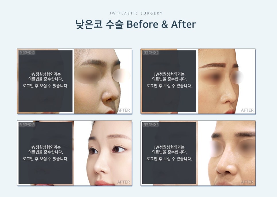 밋밋한 얼굴을 입체감 있는 얼굴로, 낮은코성형후기로 알아봐요 관련 이미지 2