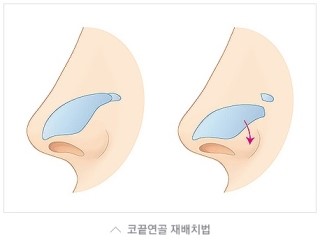 돼지코 탈출▷▶JW정원성형외과 들창코, 짧은코 교정 관련 이미지 5