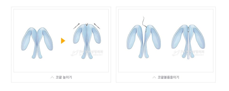 자연스럽게 움직이는 코끝, 처짐없는 코끝성형수술 알아봐요 관련 이미지 3