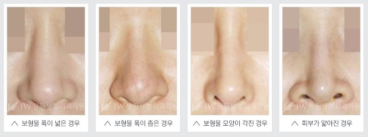 [JW정원성형외과] 코성형, 어려울수록 자신 있습니다! 관련 이미지 19