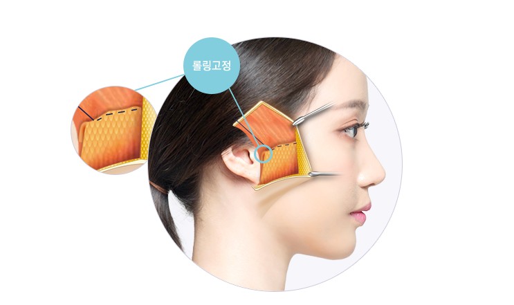 [JW정원 스마스리프팅] 꽃중년 미모의 완성, 스마스리프팅으로 관련 이미지 5