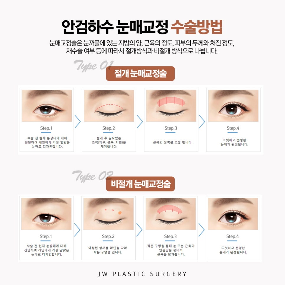 Not Just Simple Double Eyelid Surgery: Improve Eye-Opening Strength with Ptosis Correction image 3