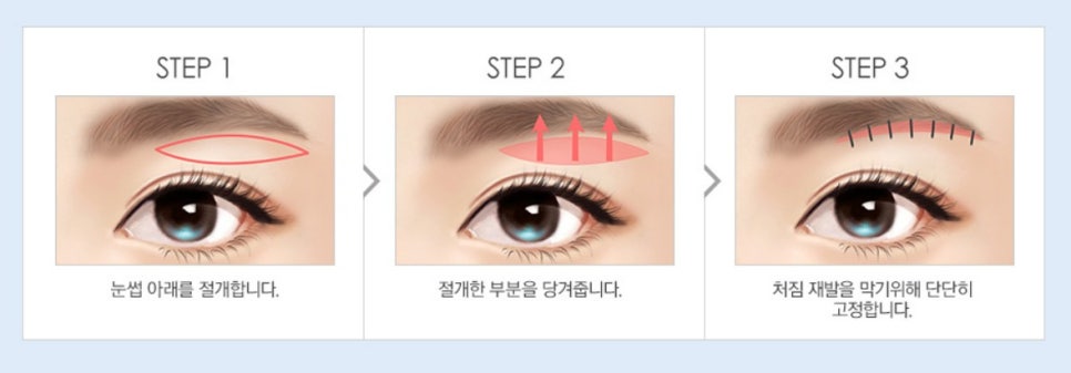 [JWJungwon Plastic Surgery] Erase the Signs of Time with Upper Blepharoplasty! image 8