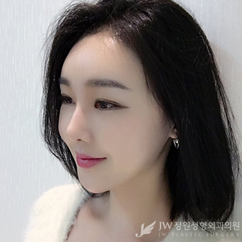 이중턱, 엘라스티꿈 리프팅으로 브이라인 만들기! JW정원성형외과 엘라스티꿈 리프팅 관련 이미지 7