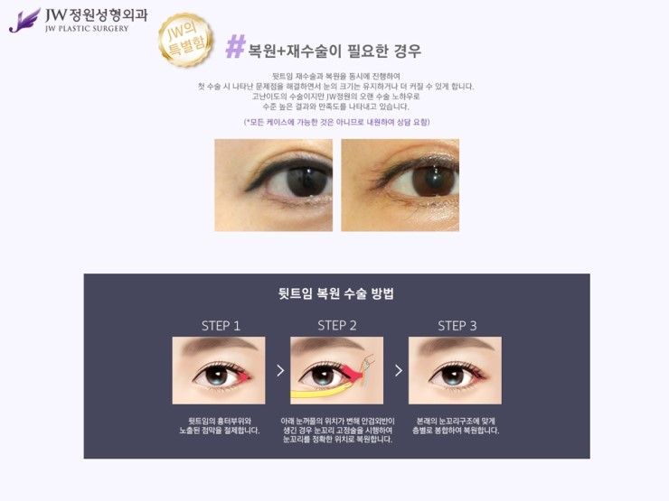 [JW정원성형외과] 앞뒷트임 재수술.복원 알아본다면? 트임복원 잘하는 곳에서! 관련 이미지 6