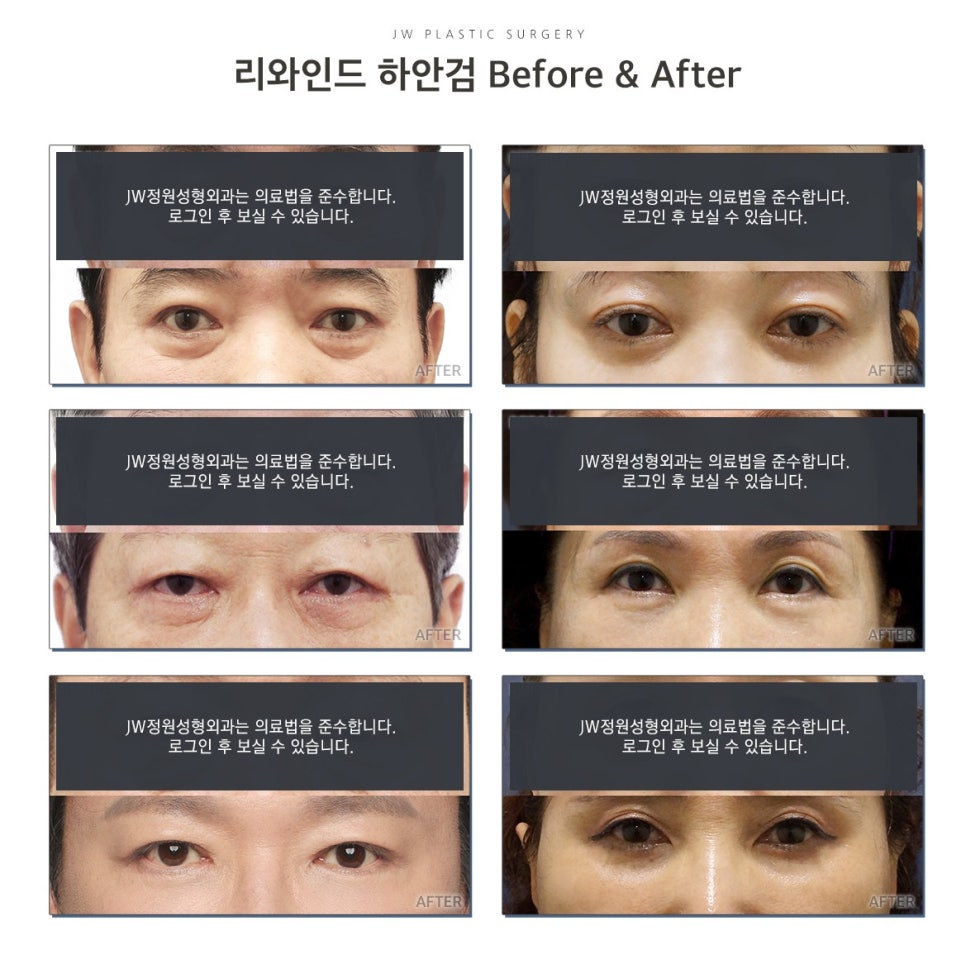 Three-Dimensional Under-Eye Contours Can Be Restored to How They Looked 10 Years Ago with Lower Blepharoplasty image 2
