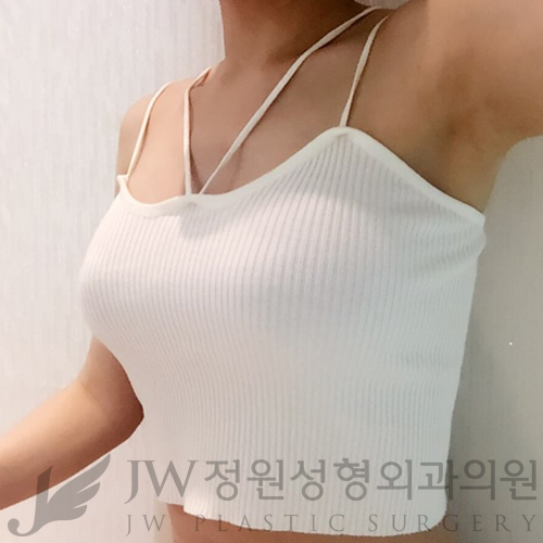 [JW정원성형외과]더 자연스러운 가슴성형, 콤비네이션가슴확대♡ 관련 이미지 3