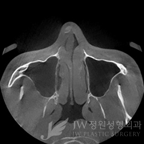 JW정원성형외과 코성형, 비중격만곡증도 같이 수술할 수 있나요? 관련 이미지 2