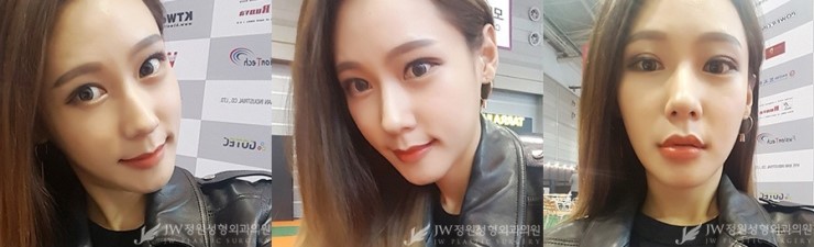 [JW정원성형외과] 턱끝재수술, 비절개눈매교정으로 동안 완성♡ 리얼셀카 관련 이미지 4