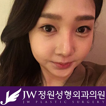 작고 답답한 눈매에서 크고 아름다운 눈매로! JW정원성형외과 트임수술 관련 이미지 3