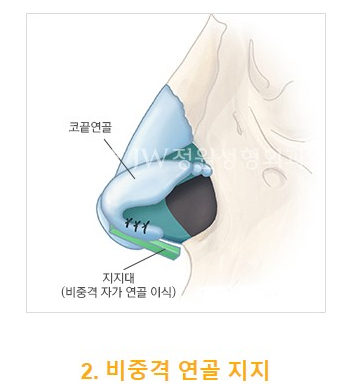 강한 인상을 부드럽게, JW정원 화살코/긴코 성형 관련 이미지 5