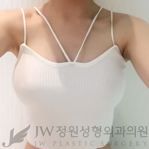 [JW정원성형외과]더 자연스러운 가슴성형, 콤비네이션가슴확대♡ 관련 이미지 2
