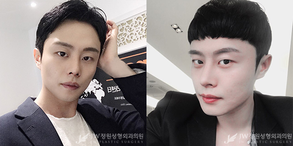 눈+코 성형으로 남성적인 이미지 UP 남자성형도 역시 JW정원성형외과! 관련 이미지 3