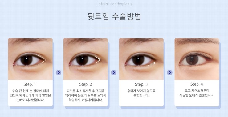 작고 답답한 눈매를 크고 시원스럽게! JW정원성형외과 360° 멀티트임 관련 이미지 6