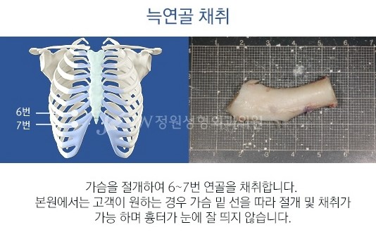 [JW정원성형외과] 코성형, 어려울수록 자신 있습니다! 관련 이미지 3