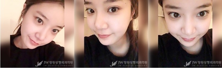 [JW정원성형외과] 안면윤곽 코성형 리얼 후기!!! 관련 이미지 6