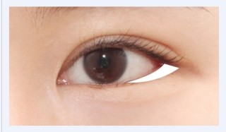 뒤트임 잘하는 병원! JW정원성형외과 뒷트임 성형 관련 이미지 2