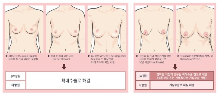 출산과 다이어트로 처진 가슴! JW정원성형외과 처짐교정 확대술! 관련 이미지 2